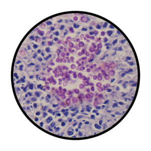 Candidiasis