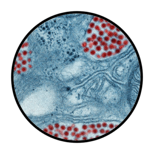Encephalitis Sample