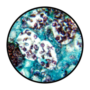 Histoplasmosis